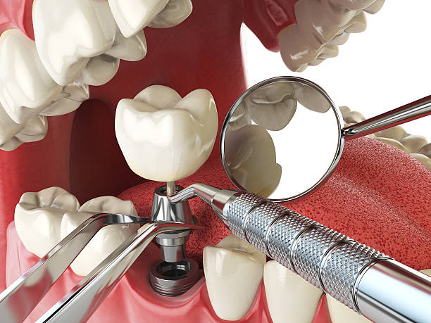 Best Emergency Dental Filling Replacement  in Henderson, TX